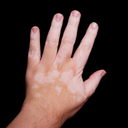 vitiligo